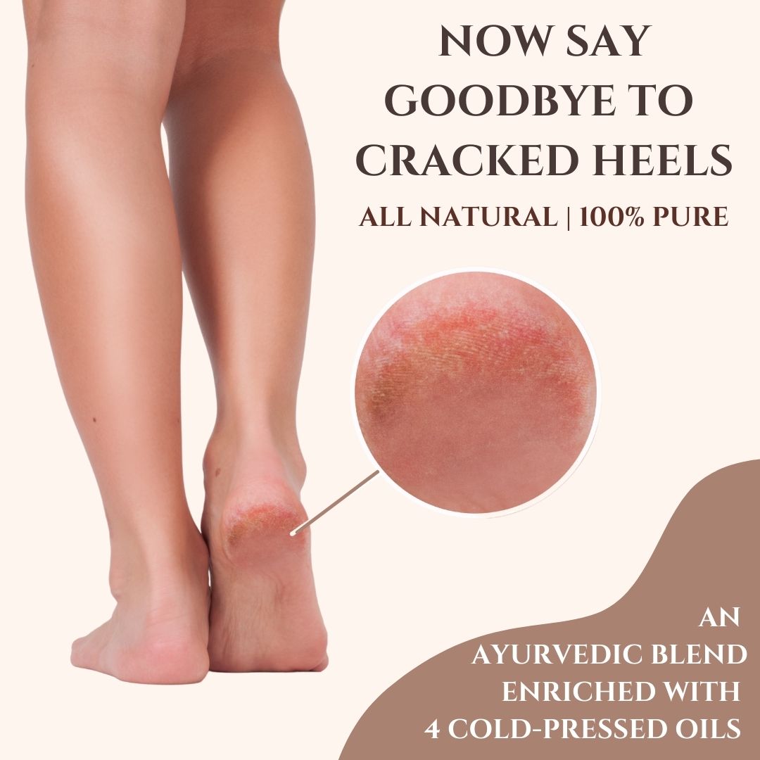Treating Cracked Heels With Ayurveda - Boldsky.com